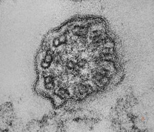 F,5y. | immotile cilia syndrome - nasal mucosa F,5y. | immotile cilia syndrome - nasal mucosa